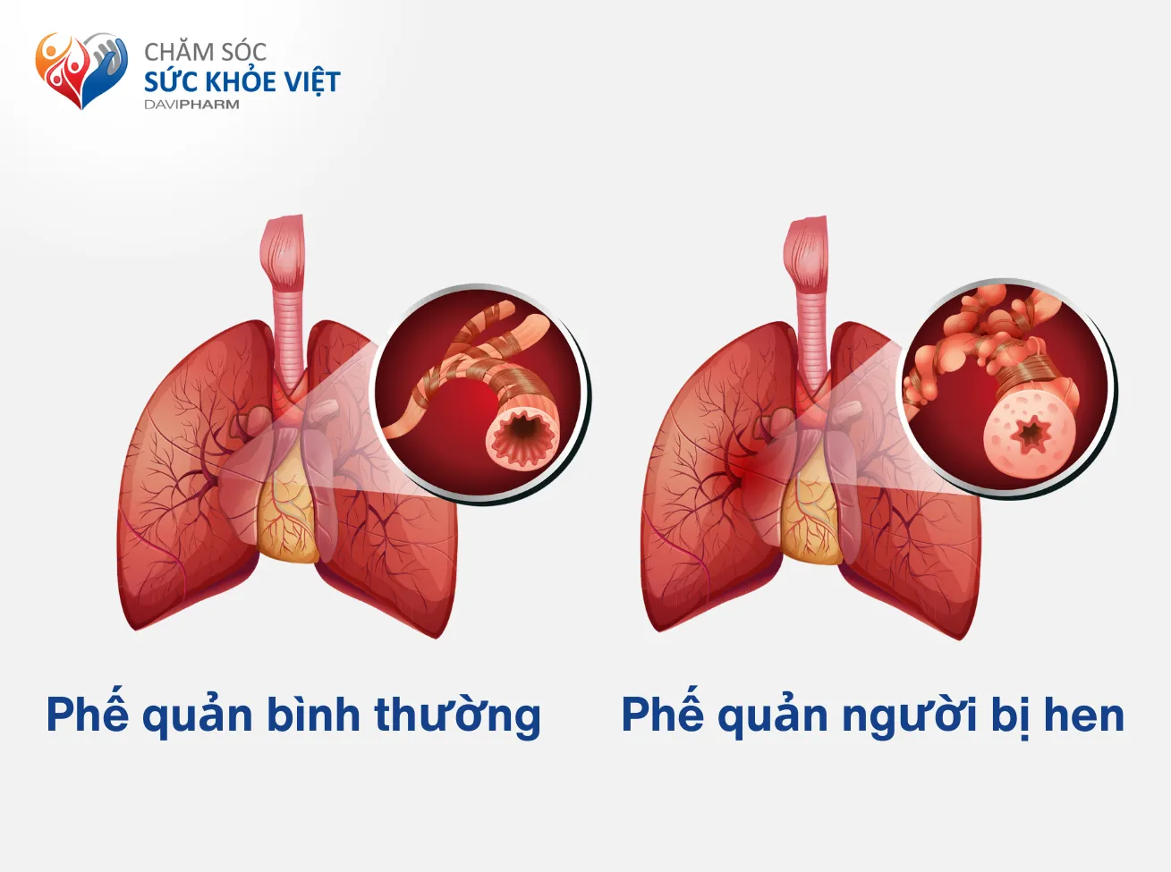 HEN PHẾ QUẢN: ĐIỀU TRỊ VÀ DỰ PHÒNG NHƯ THẾ NÀO?