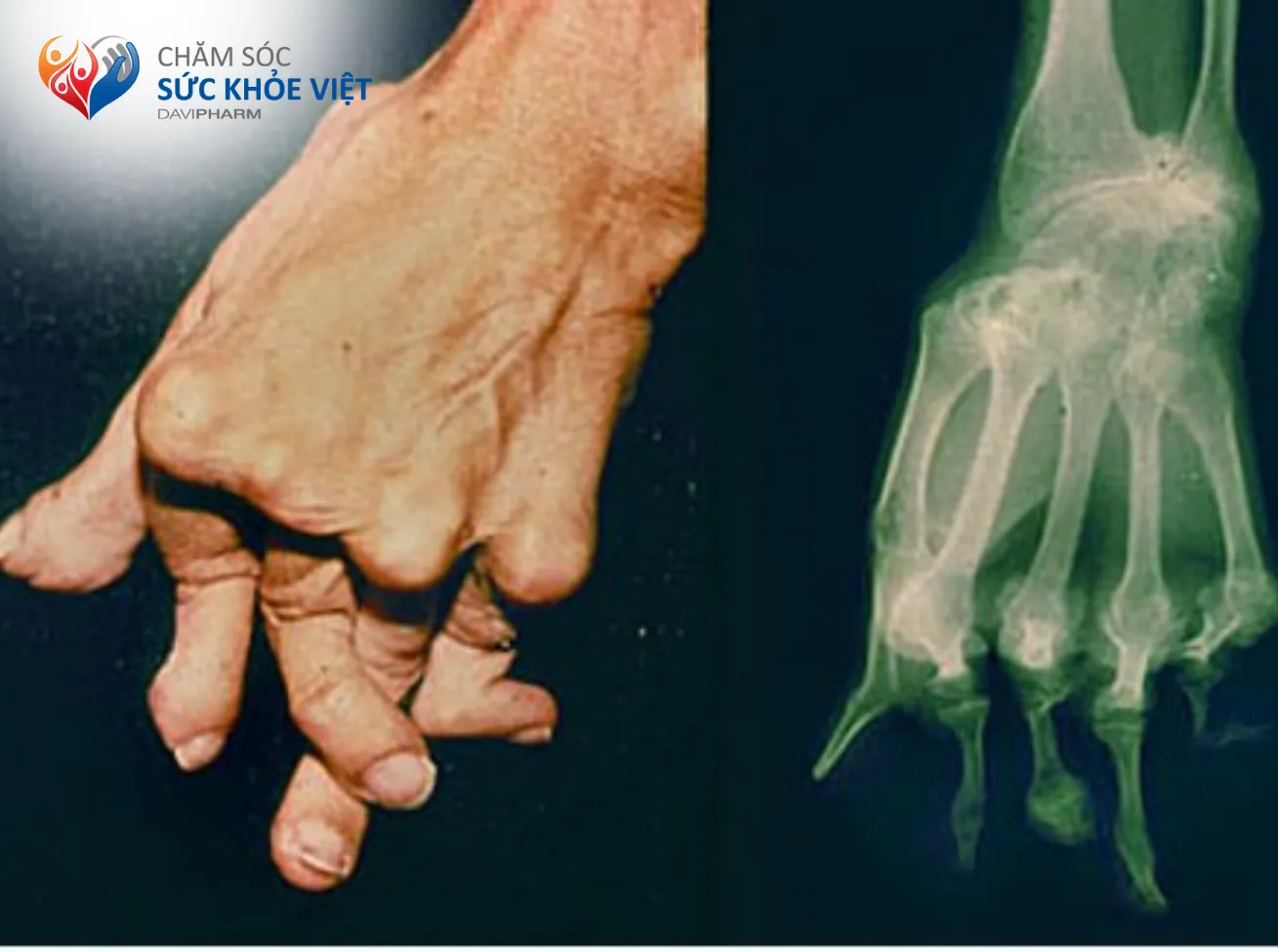Viêm khớp vảy nến làm khớp bị biến dạng và có thể gây tàn phế suốt đời