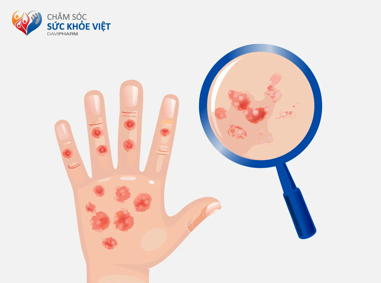 BỆNH CHÀM DA (ECZEMA) Ở TRẺ EM: CHĂM SÓC VÀ ĐIỀU TRỊ NHƯ THẾ NÀO?