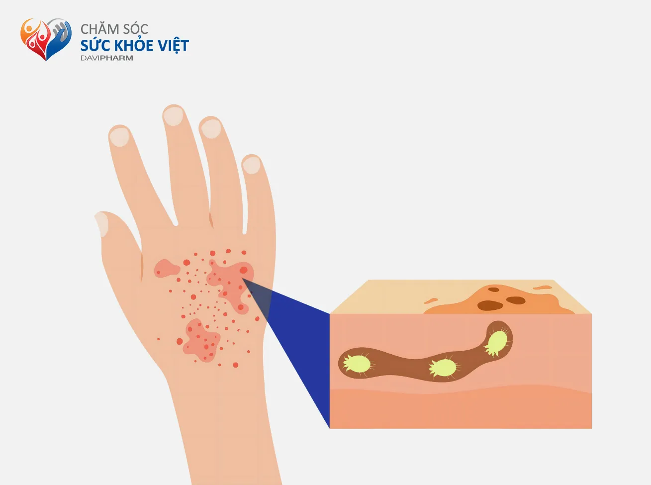 NHẬN BIẾT VÀ ĐIỀU TRỊ BỆNH CHỐC LỞ Ở TRẺ EM