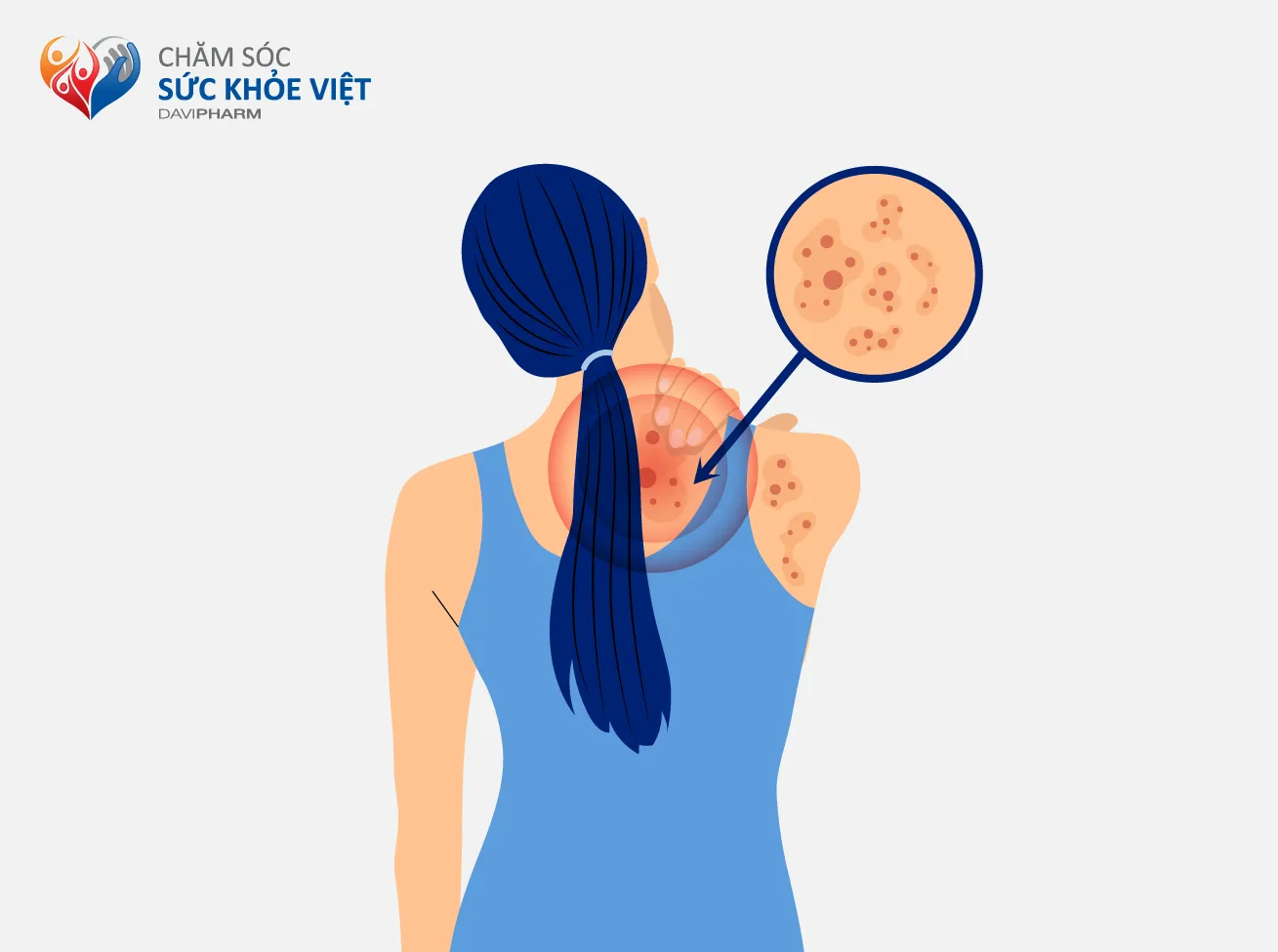 TỔNG HỢP MẸO VÀ THUỐC ĐIỀU TRỊ ZONA THẦN KINH