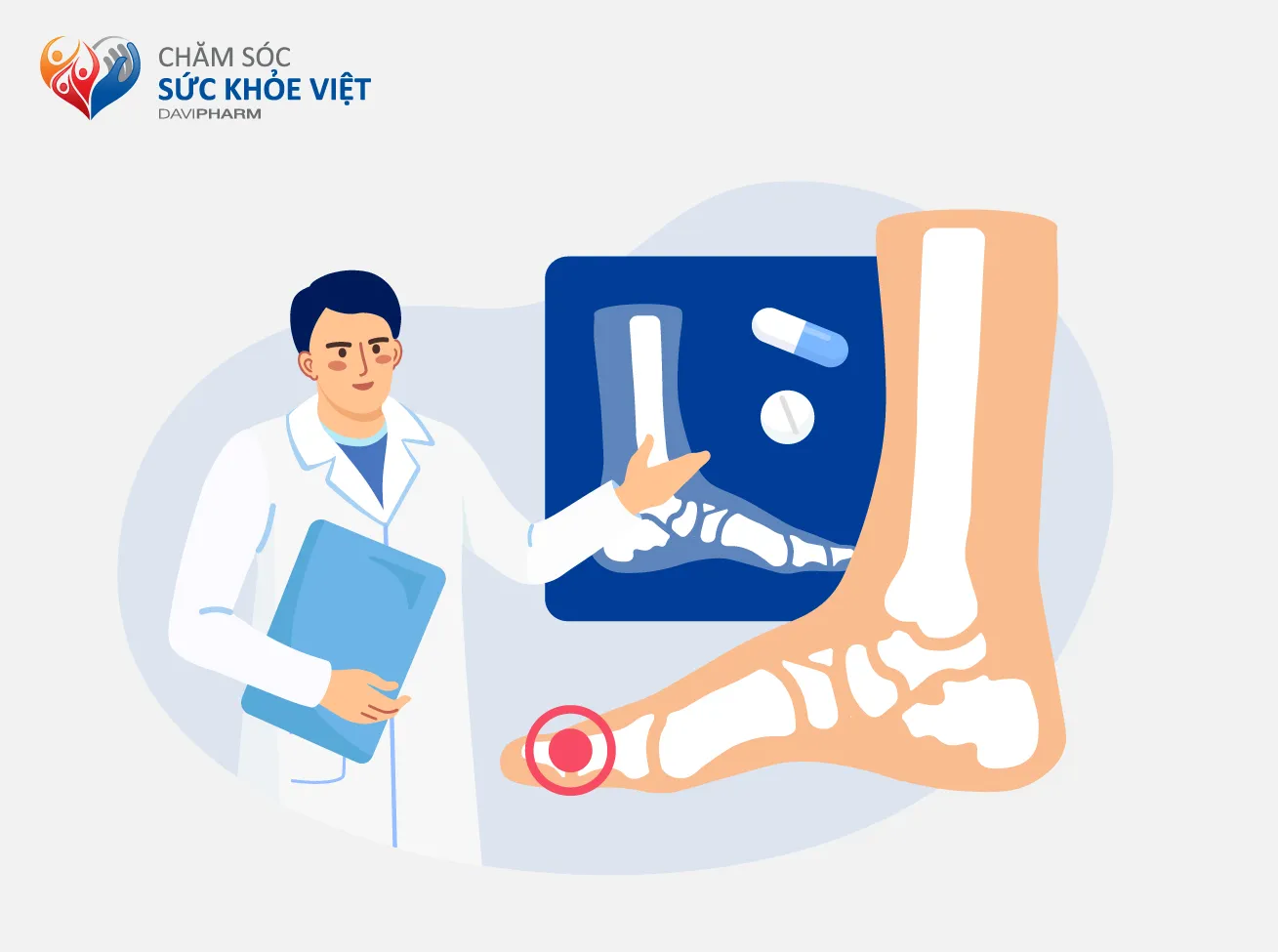 4 LOẠI THUỐC GIẢM ĐAU GOUT CẤP MÀ BẠN CẦN PHẢI BIẾT