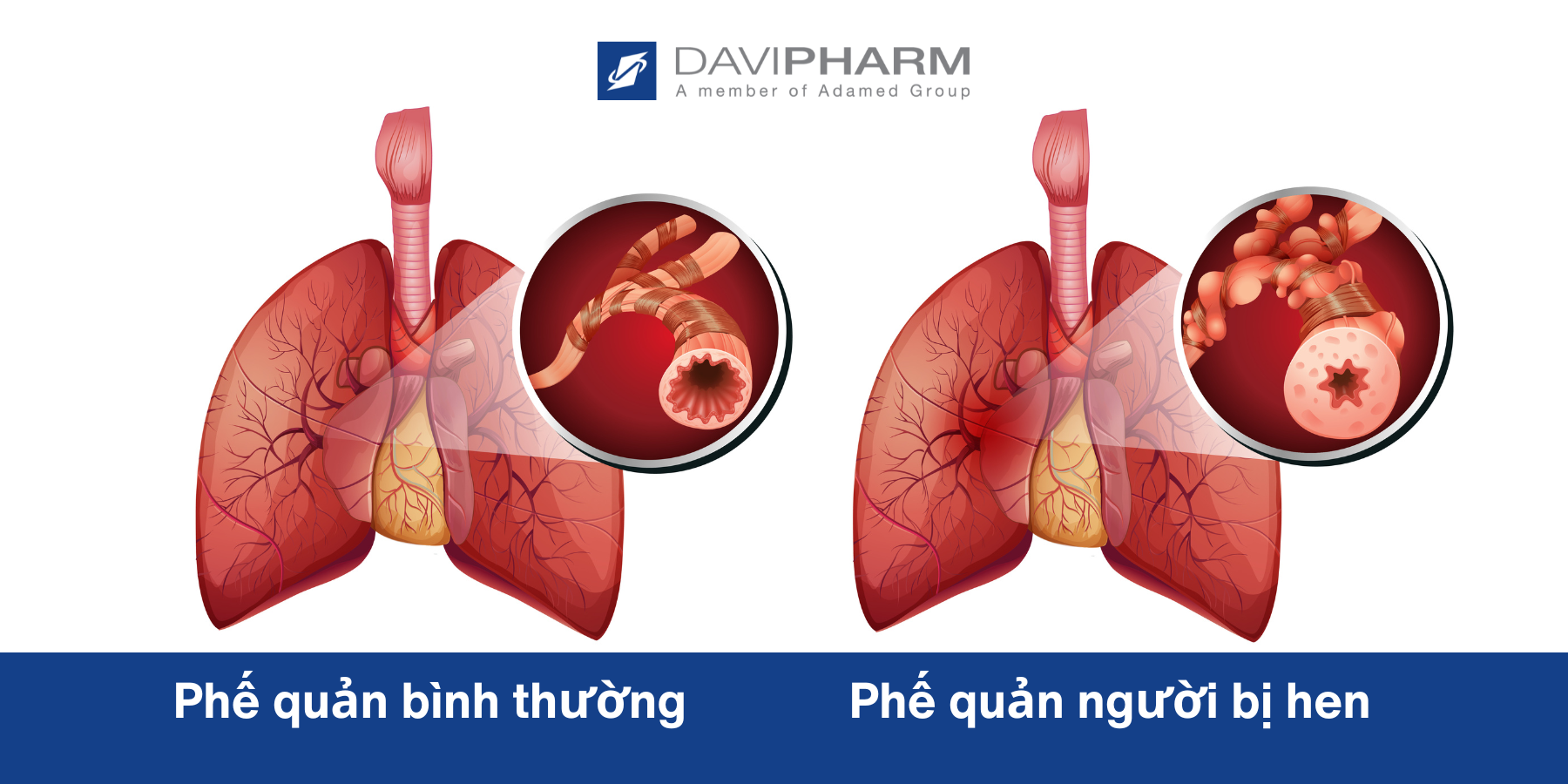 Phế quản bình thường và người bị hen