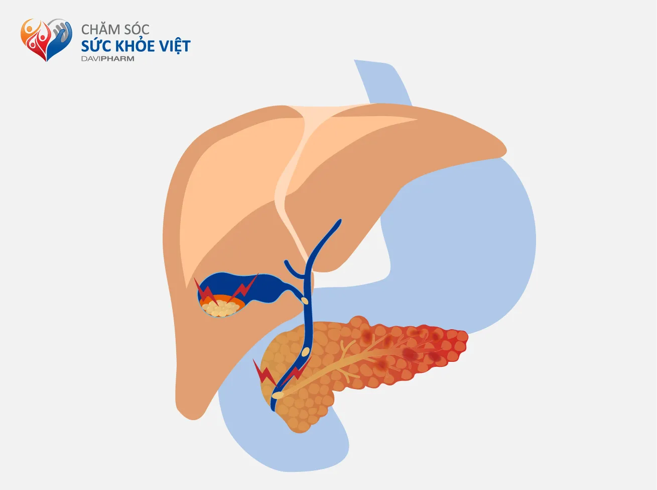 SỎI TÚI MẬT CÓ NGUY HIỂM KHÔNG? 80% BỆNH NHÂN KHÔNG CÓ TRIỆU CHỨNG