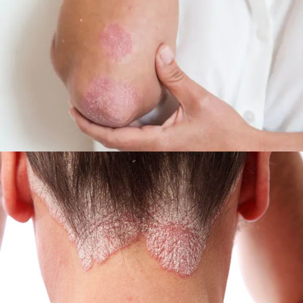 Vảy nến khuỷu tay - vảy nến da đầu