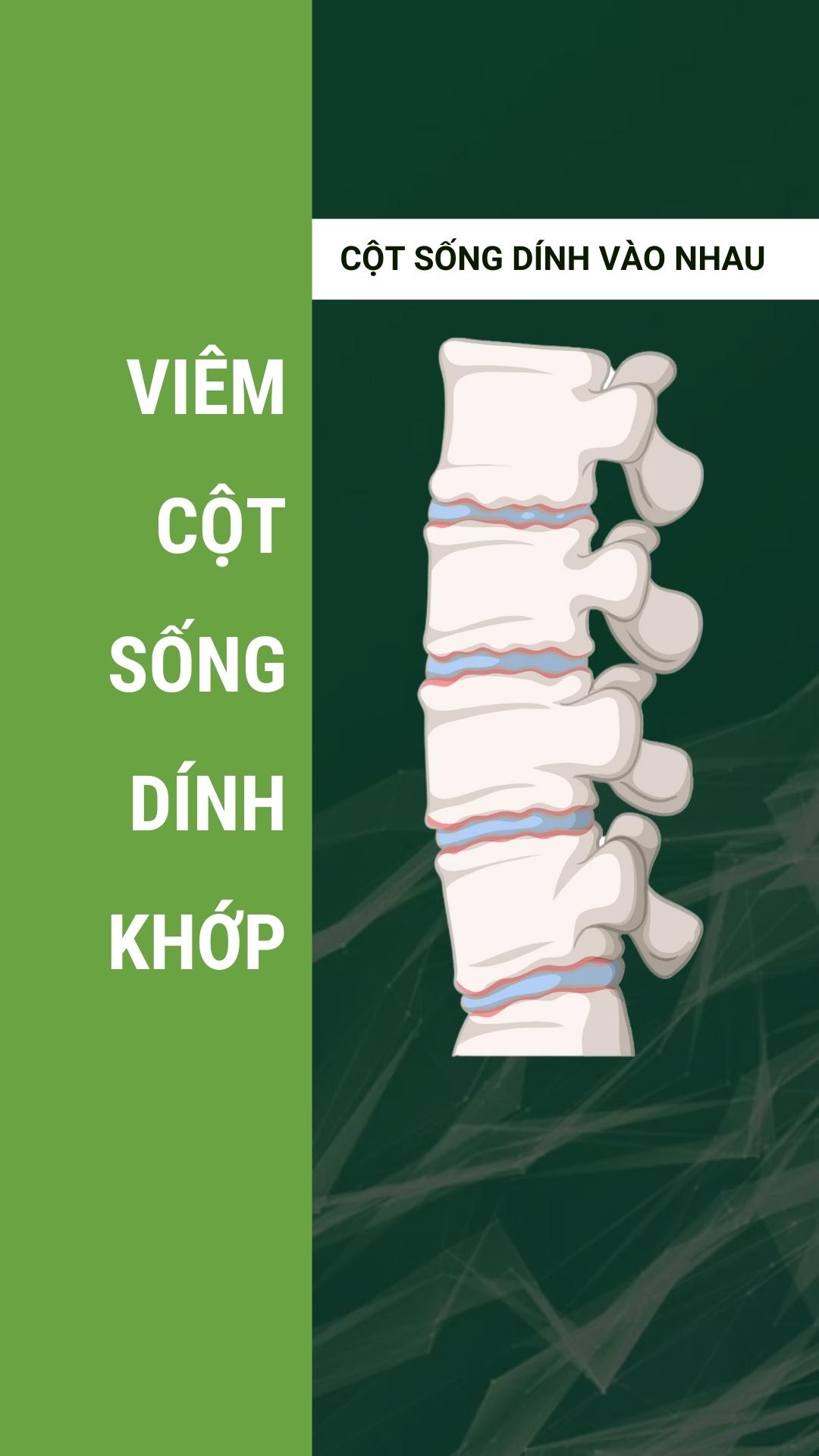 dấu hiệu viêm cột sống dinh khớp