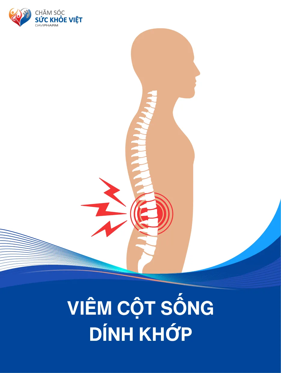 Dấu hiệu viêm cột sống dính khớp