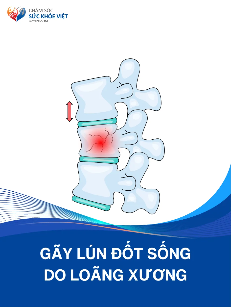 Gãy lún đốt sống do loãng xương