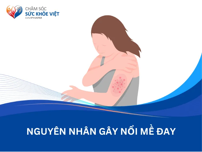 Nguyên nhân gây nổi mề đay