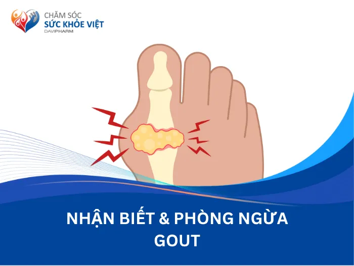 Những thông tin về Gout mà ai cũng cần phải biết!