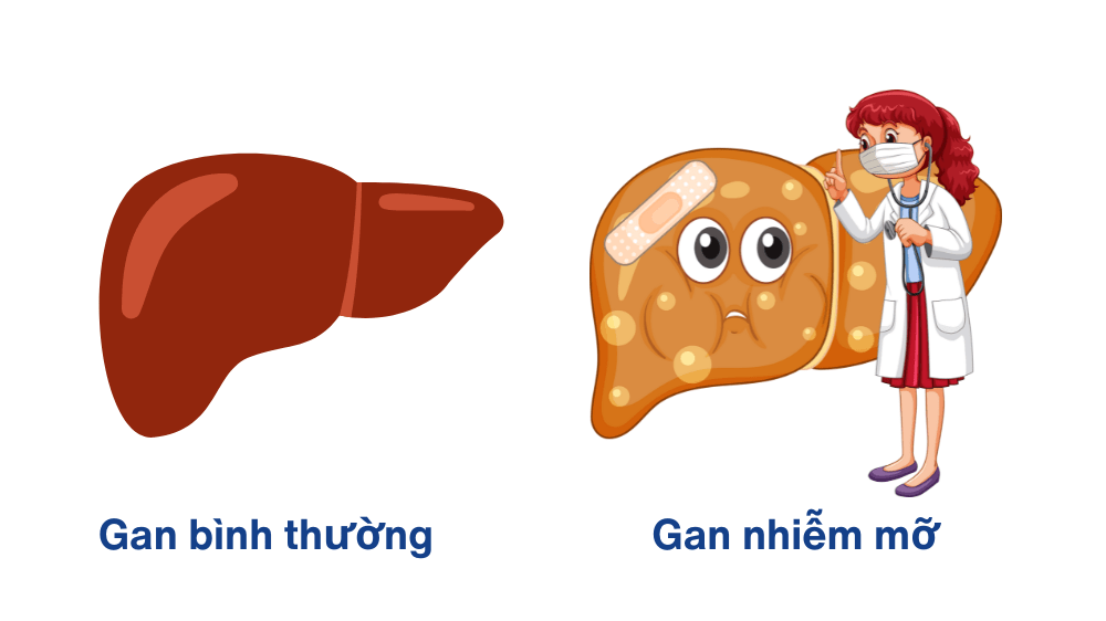 gan nhiễm mỡ nên ăn và kiêng gì