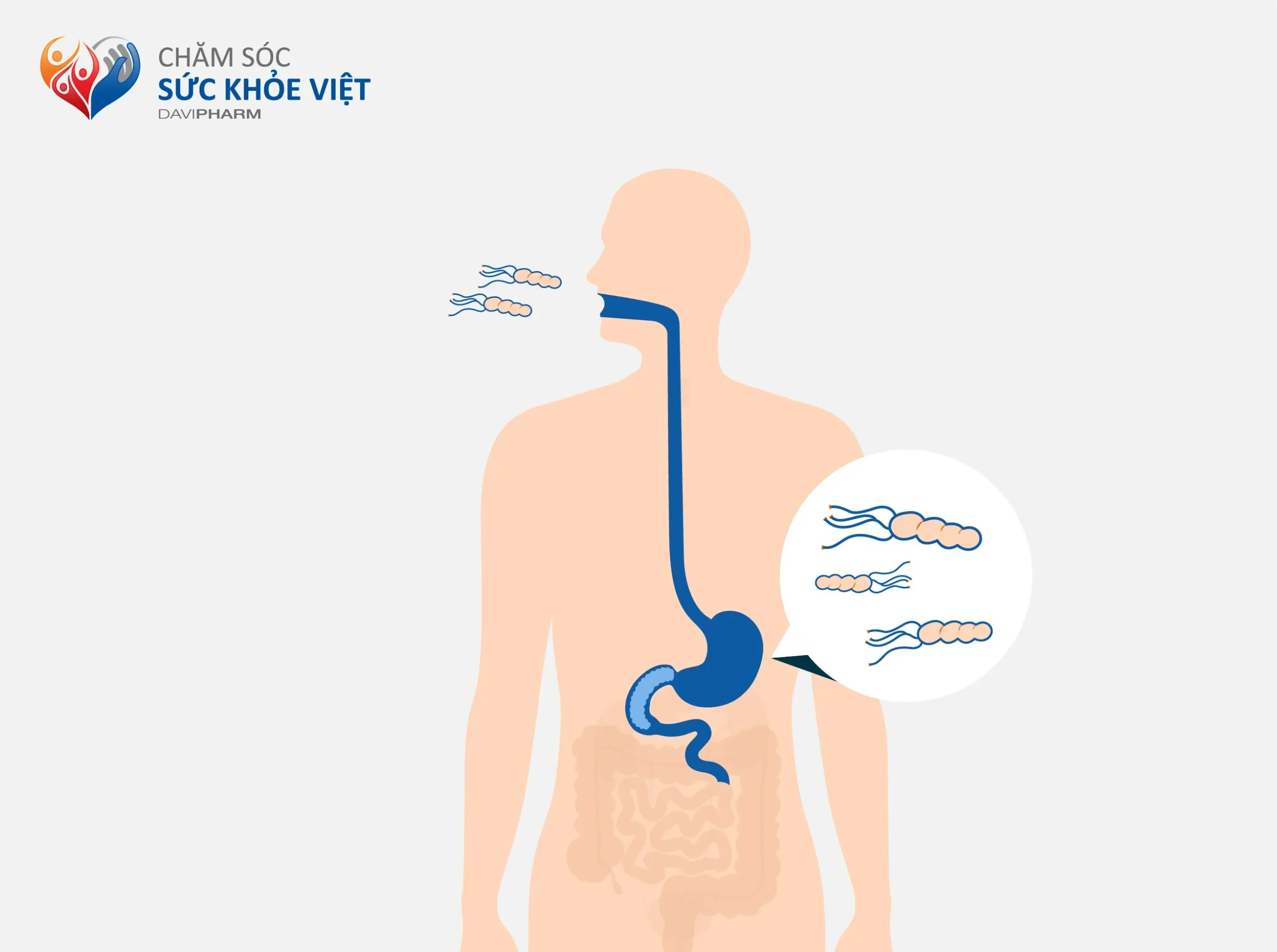 4 ĐIỀU CẦN BIẾT VỀ NHIỄM KHUẨN HELICOBACTER PYLORI