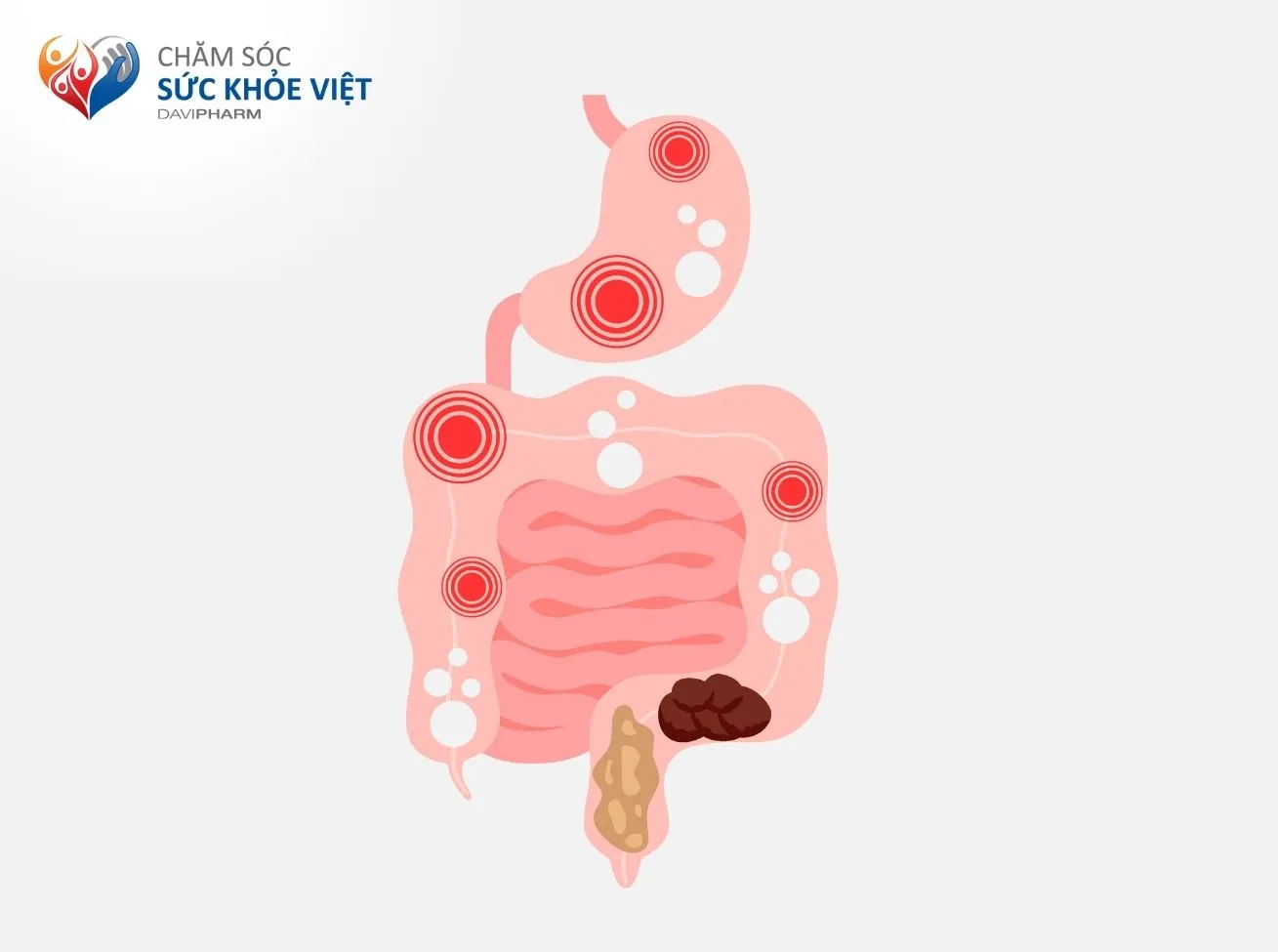Tiêu chảy, táo bón và đầy bụng là các triệu chứng trên đường ruột thường gặp