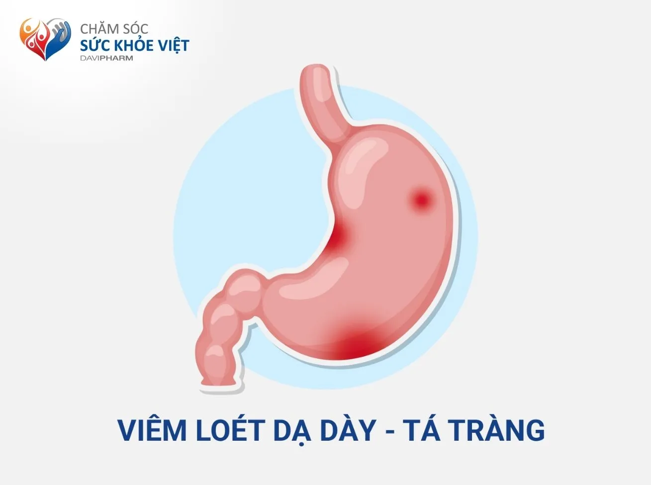 Viêm dạ dày, loét dạ dày – tá tràng là các ảnh hưởng thường gặp khi lạm dụng thuốc NSAID