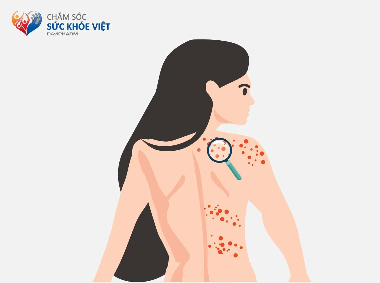 BỆNH ĐAU THẦN KINH SAU ZONA – NGUYÊN NHÂN & HẬU QUẢ