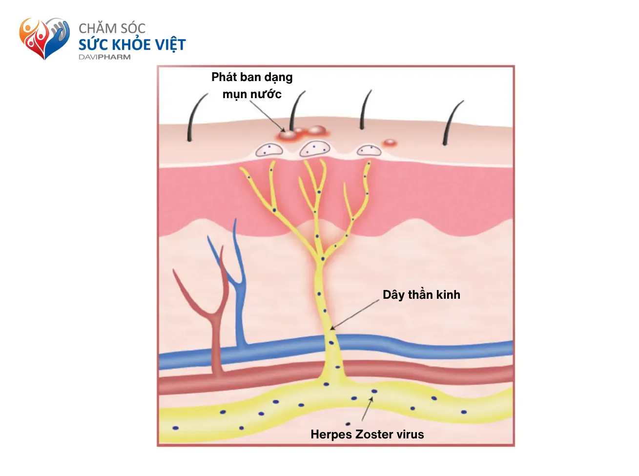 Bệnh Zona gây biến chứng tổn thương các dây thần kinh ở vùng da tổn thương và gây triệu chứng đau dai dẳng kéo dài