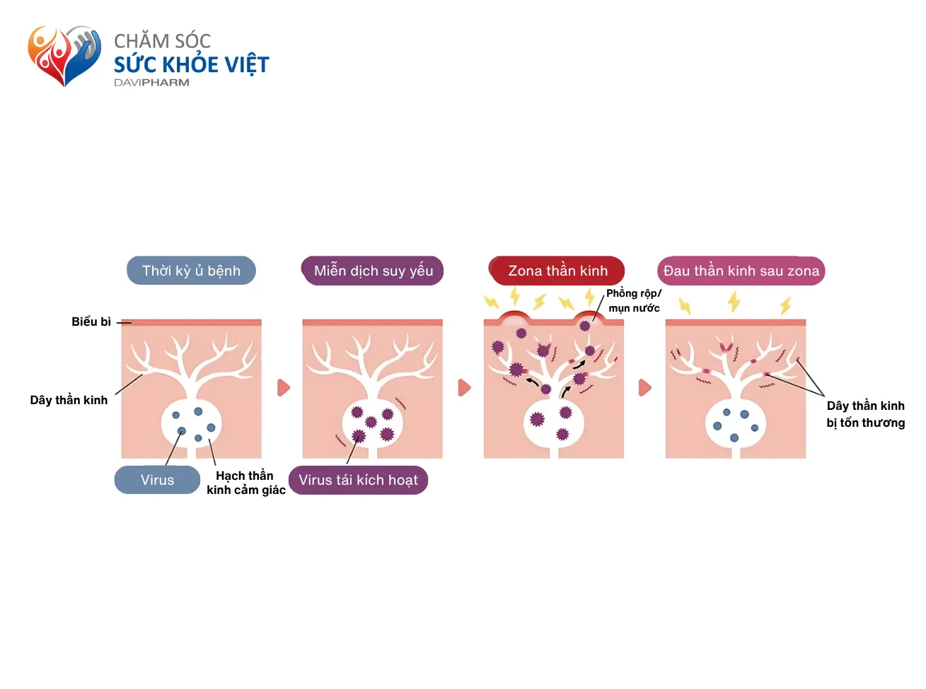 Minh họa về tiến trình bệnh lý đau thần kinh sau Zona