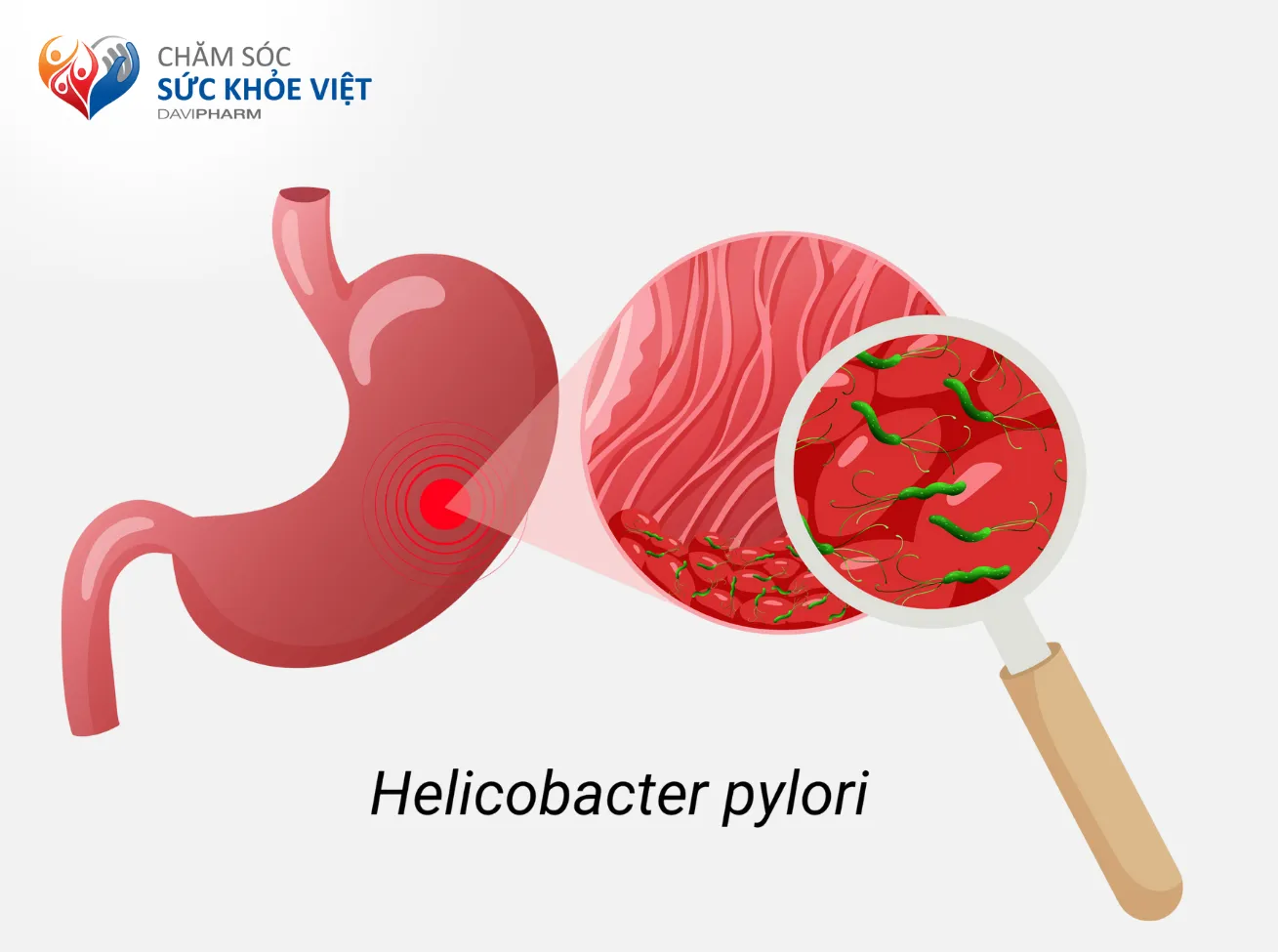 Helicobacter pylori gây viêm loét dạ dày