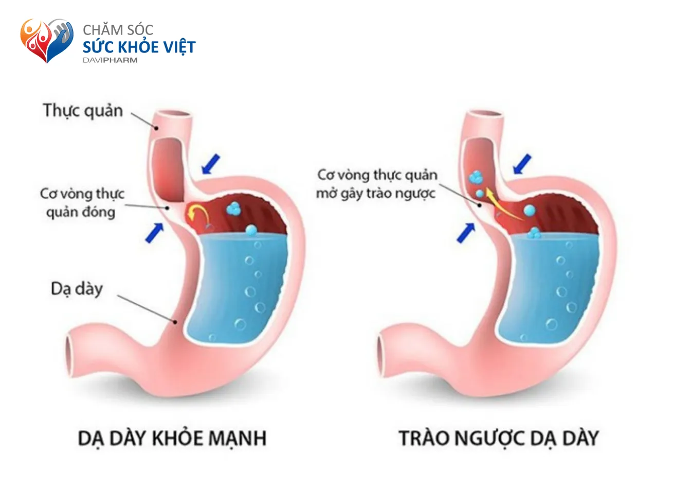 cơ vòng thực quản dưới không đóng kín gây trào ngược dạ dày thực quản