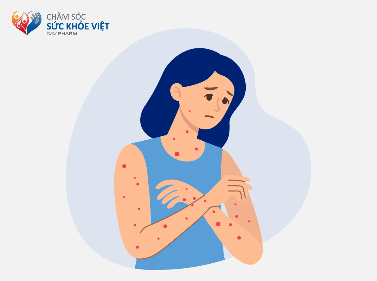 Nổi mày đay cấp và dấu hiệu cần đi khám.