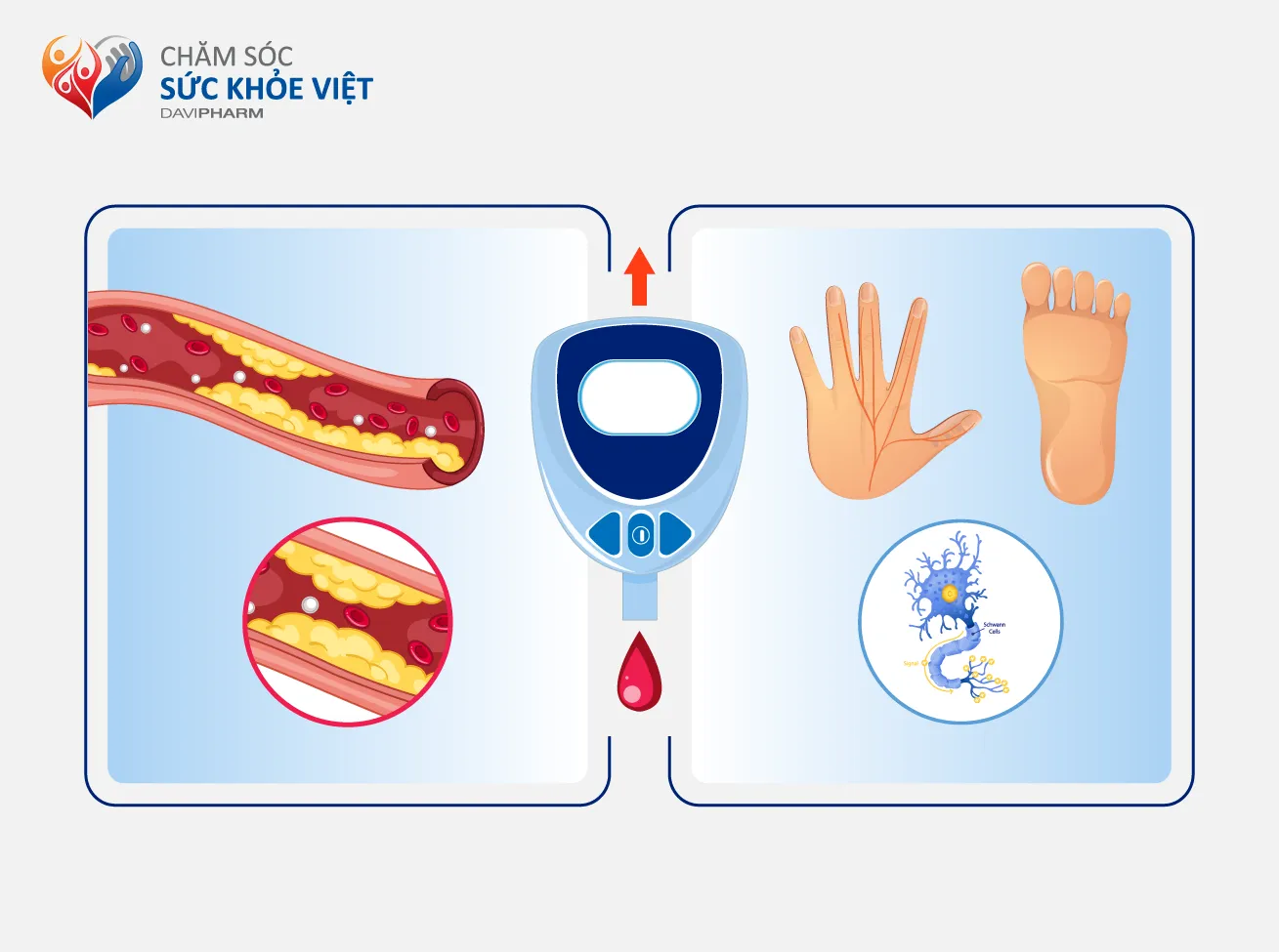 Hình 2: Đường huyết cao kéo dài gây tổn thương mạch máu và thần kinh 
